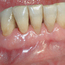 Bildet viser tilsynelatende normale tannkjøttsforhold ved tenner i underkjeven.