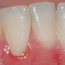 Bildet viser belegg langs tannkjøttet på en fortann i underkjeven. Tannkjøttet er noe rødt og hovent.