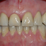 Slik fikk pasienten tilbake en normal bittfunksjon, og et pe¬nere tannsett.