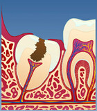 Fig 5: Vansker med renhold kan over tid kan gjøre at det utvikles hull i selve visdomstannen