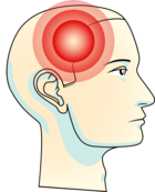 Tanngnissing kan forplante seg videre til tinninger