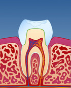 Illustrasjon av bittskinne på gipsmodell
