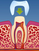 Fig 12: Etter ca. 1-2 uker er den permanente kronen ferdig og kan sementeres på plass
