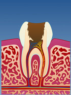 Fig 1: Irreversibel pulpitt