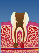 Fig 2: Ubehandlet irreversibel pulpitt