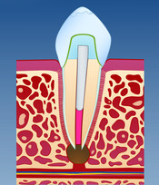 Illustrasjon av infeksjon ved rotspissen