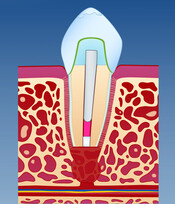 Illustrasjon av utført operasjon