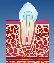 Illustrasjon av endt tilheling