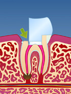 Fig 4: Dersom rotfyllingen blir utsatt for lekkasje, kan bakterier lage en ny infeksjon
