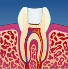 Fig 3: Den midlertidige fyllingen legger til rette for at nerven kan “trekke seg sammen”