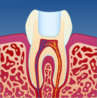 Fig 4: Man fjerner den midlertidige fyllingen, renser helt rent og legger en permanent fylling