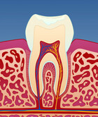 Fig 1: Illustrasjon av utvikling av karies