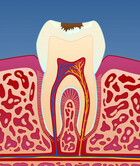 Fig 2: Illustrasjon av utvikling av karies
