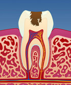 Fig 3: Illustrasjon av utvikling av karies