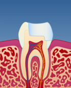 Fig 4: Innlegget er ferdig og kan sementeres på plass