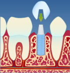 Fig 3: Kjevebenet tilheler rundt implantatet, slik at implantatet kan fungere som feste