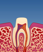 Fig 2: Tannen slipes og formes til slik at kronen kan sementeres utenpå