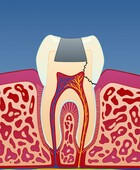 Fig 2: Infraksjonen kan imidlertid også gå inn til nerven