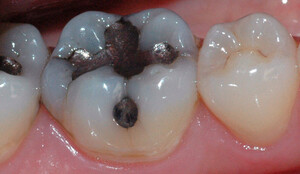  Amalgamfylling i tann