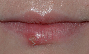 Utbrudd av herpesvirus